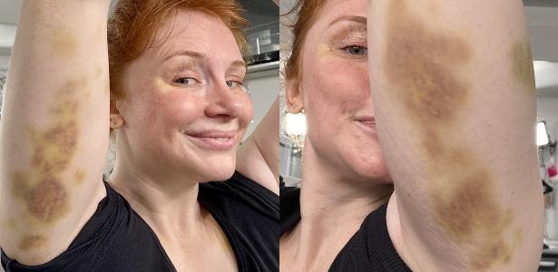 Bryce Dallas Howard mostra hematomas de ‘Jurassic World’ – 16.07.2020